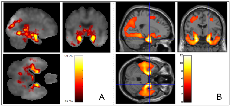 Tau PET brain scans analyzed by deep learning